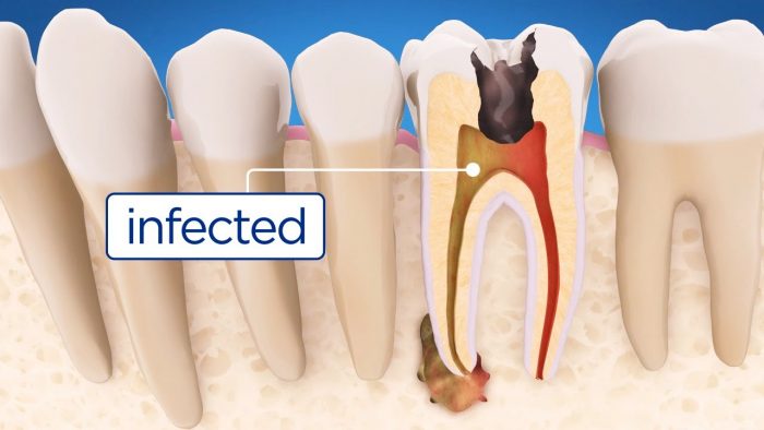 ¿Cuándo es necesario realizarse una endodoncia?
